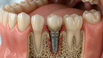 How Personalised Treatment Planning Improves Implant Success